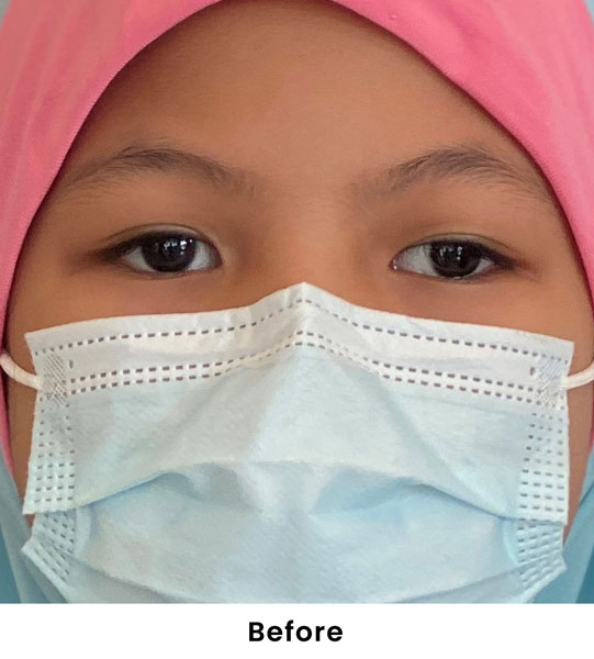 Squint Treatment for Children: A Life-Changing Experience