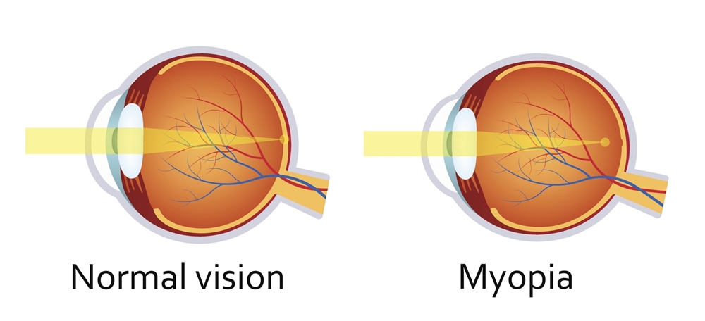 Can you prevent or slow down myopia in children? 